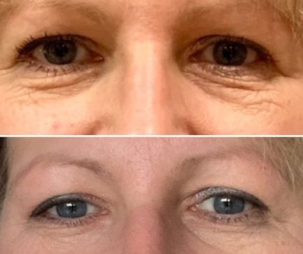 before and after zone face lift