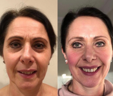 before and after zone face lift